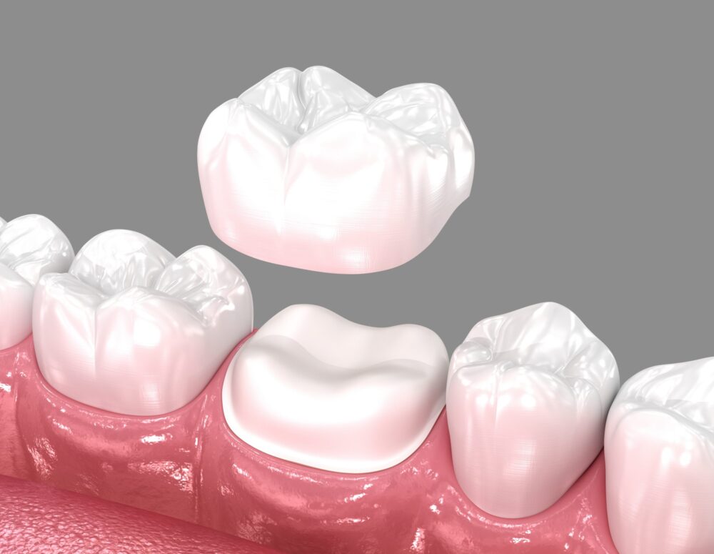 Affordable dental crowns in Guntersville
